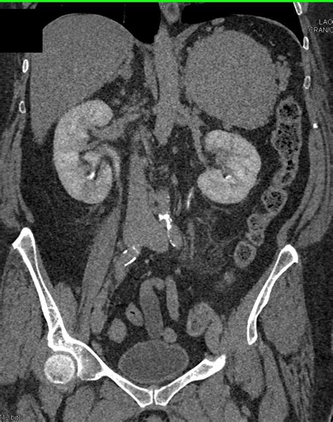 Acute Pyelonephritis Best Seen In The Left Kidney Kidney Case Studies