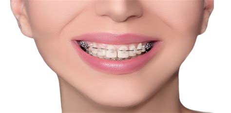 Your Visual Guide To Different Types Of Braces Langley Braces Aura