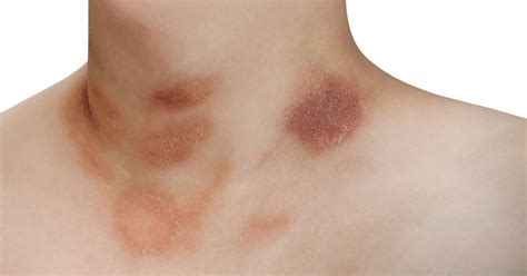 Pityriasis Rosea Causes Symptoms Diagnosis And Treatment