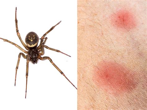 How Do You Feel After A Spider Bite Most Spiders Only Bite When They Feel Threatened But It S