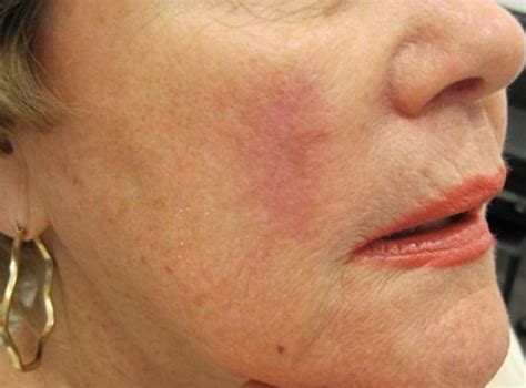 Contour Dermatology Woman Facial Scar After Web Contour Dermatology