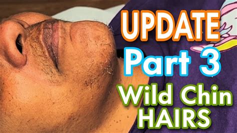 Part 3 Waxing Wildsporadic Chin Hairs She Drives An Hour Each Time🥰