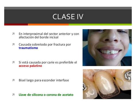 Clases De Black Odontologia