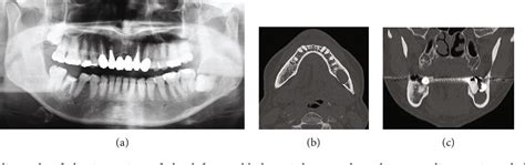 Figure 1 From A Rare Case Of Pyogenic Granuloma In The Tooth Extraction