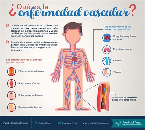 ¿qué Es La Enfermedad Vascular Infografía De Medical Times