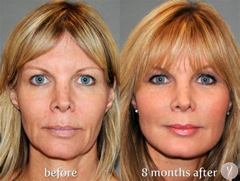 The Y Lift Face Lift Procedure Phoenix Skin Y Lift Before And After Y