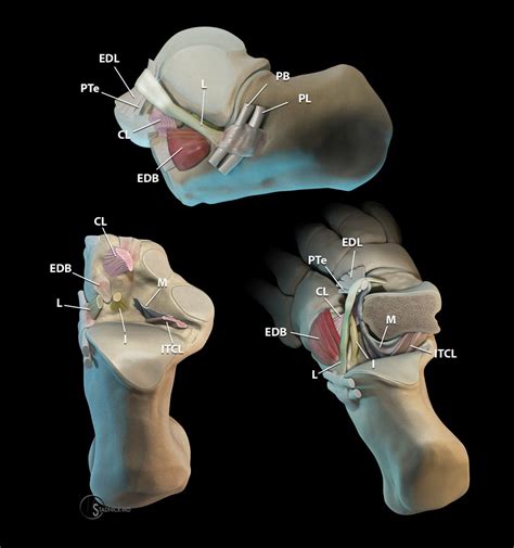 Sinus Tarsi Syndrome Radsource