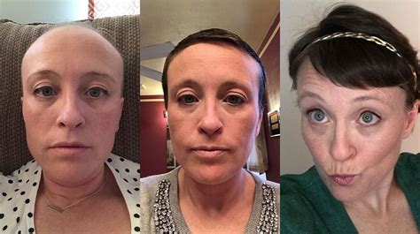 There's no doubt about it, we all want a luxurious, full head of hair. My Chemotherapy Diary: 52 Photos of Hair Loss and Recovery