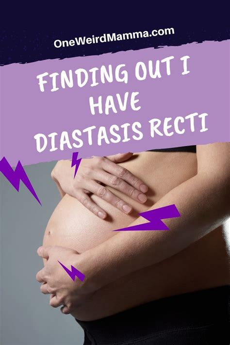 Diastasis Recti My Diagnosis With Images Diastasis Recti