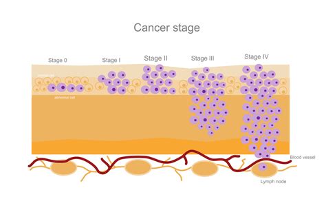 Metastatic Breast Cancer Pharmacologic Management Cancer Therapy Advisor