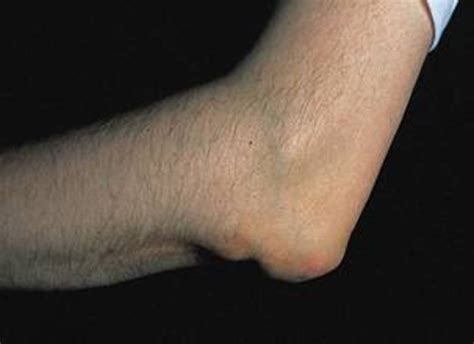 Rheumatoid Nodules Guaranteed Indicators Of Rheumatoid Arthritis