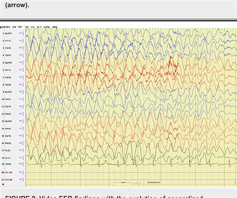 Figure 2 From New Onset Seizures As An Acute Presentation With Atypical