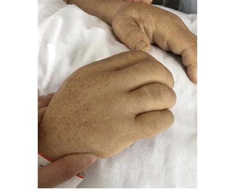 Patients Hands With Bilateral Edema Download Scientific Diagram