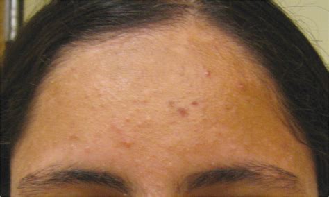 Diagnosis And Treatment Of Acne Aafp