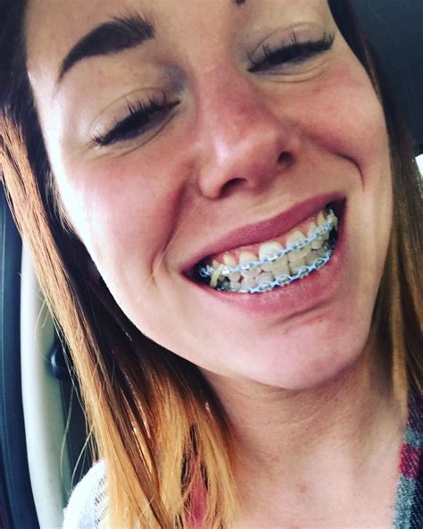 Clear Braces With Colored Rubber Bands Gaudy Cyberzine Stills Gallery