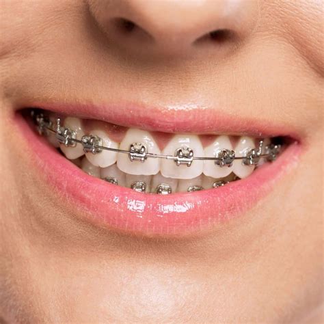 Types of Braces - Drake Orthodontics