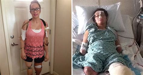 meet the human mannequin brave woman who lost limbs to meningitis is now 40 per cent plastic