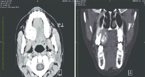 A Contrast Enhanced Computed Tomography Axial Scan Shows An Eccentric