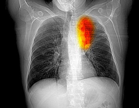 Lung cancer is commonly associated with smoking. Lung cancer survival 'depends on where you live' as more ...