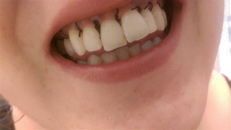 Stitches Dissolve After Wisdom Teeth Removal Teethwalls