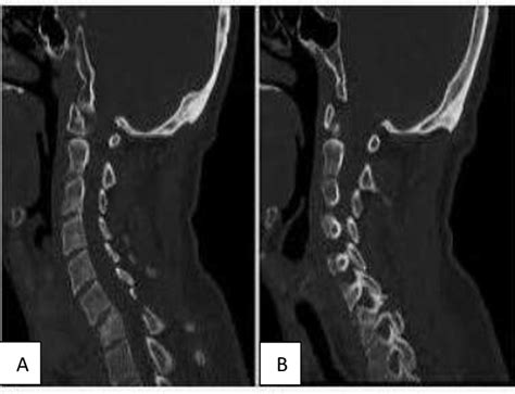 Ct Cervical Spine Fracture Showed Multiple Fractured Vertebrae A