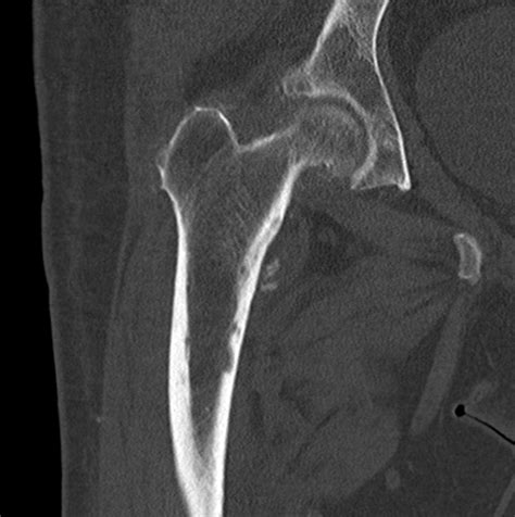 Greater and lesser trochanter fracture causes & treatment. Pathological lesser trochanter fracture | Image ...