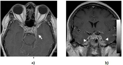 A Rare Case Of Cavernous Sinus Syndrome In A Patient With