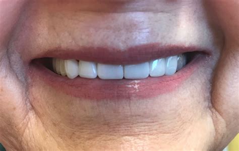 Cosmetic Dentistry Before And After Photos Nobel Dental Care