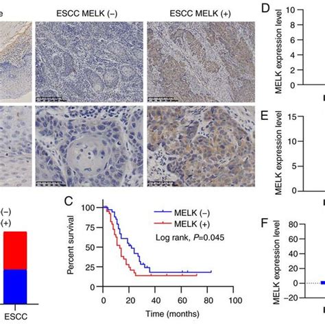 Melk Expression Is Elevated And Associated With Poor Prognosis In Escc