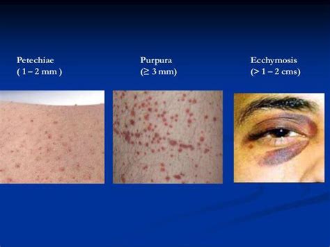 Petechiae Vs Ecchymosis Vs Purpura Medizzy