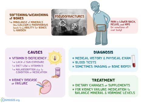 Osteomalacia What Is It Causes Symptoms And More Osmosis