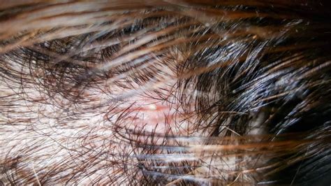 Abscess On Skin Head Stock Photo Image Of Healthcare 103441606