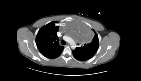 Ct Chest Coronal View Showing The Anterior Mediastinal Mass With