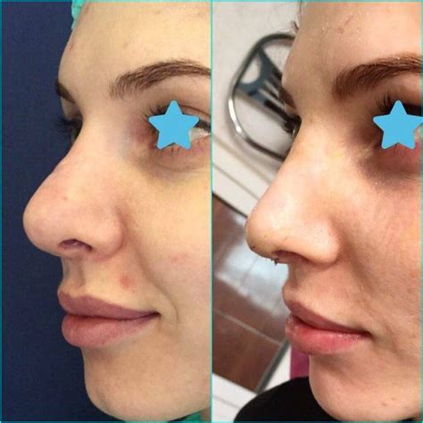 Bulbous Tip Before And After Photos Rhinoplasty Nose Reshaping