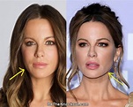 Kate Beckinsale Plastic Surgery Comparison Photos