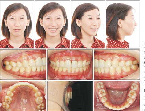 PDF Nonsurgical Correction Of A Severe Anterior Deep Overbite