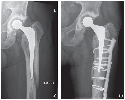 Postoperative Periprosthetic Femoral Fracture Around Total Hip