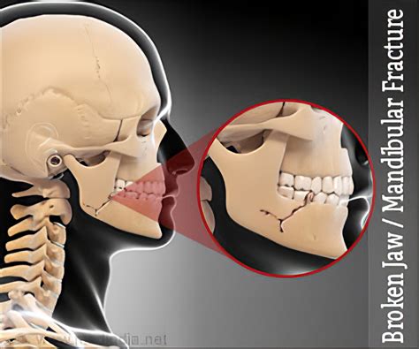 Maxillary Fracture Classification