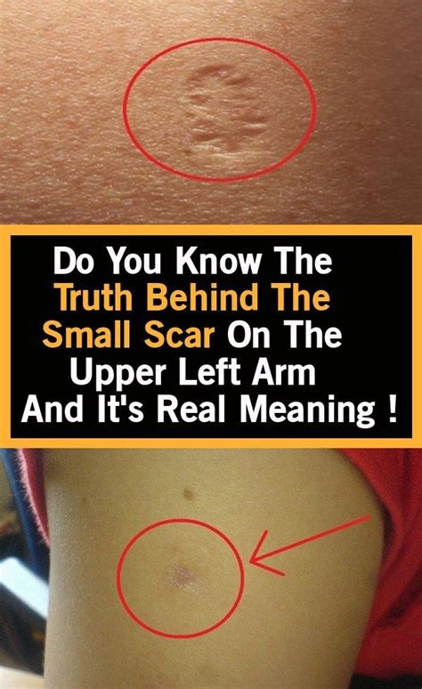 Do You Know The Truth Behind The Small Scar On The Upper Left Arm And