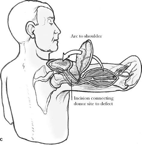 Soft Tissue Coverage Of The Shoulder Musculoskeletal Key