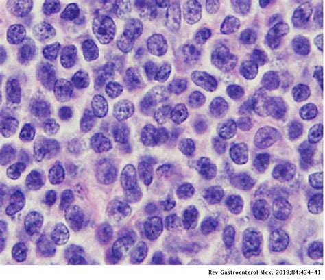 Mantle Cell Lymphoma Cytology Images And Photos Finder