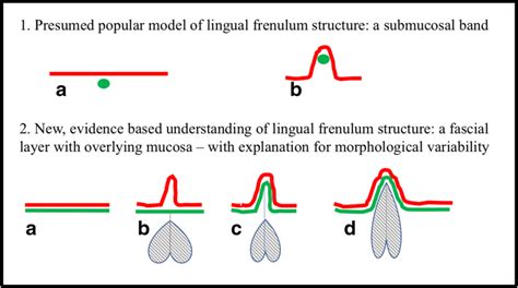 Anatomically Based Understanding Of The Lingual Frenulum According To