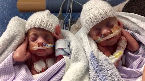 Miracle Twins Born At 24 Weeks Beat The Odds To Survive And Are Now