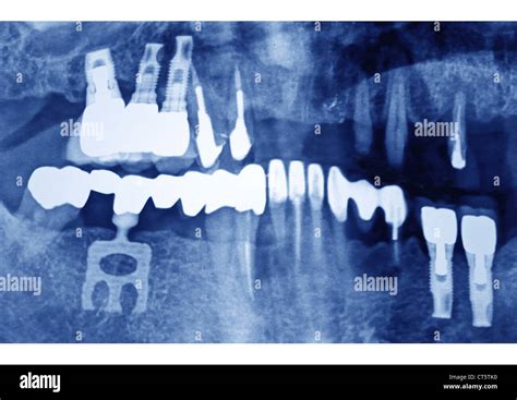 Dental Implant X Ray Stock Photo Alamy