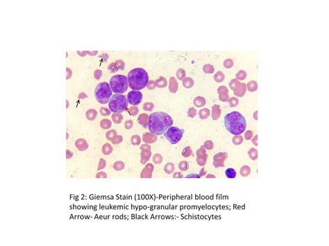 Microgranular Acute Promyelocytic Leukemia With Hyperleukocytosis And