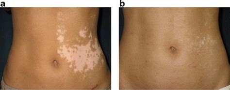 Treatment Of Segmental Vitiligo In Case 18 A Before Surgery B Two