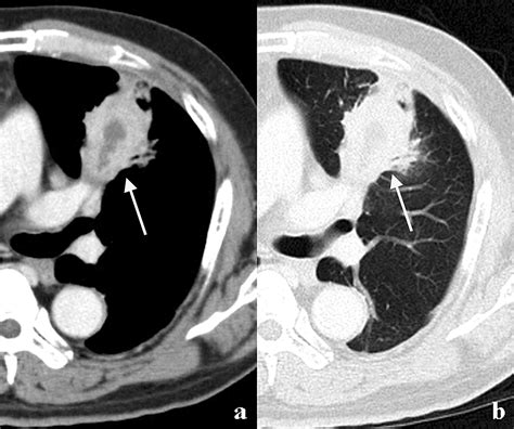 Cureus Pulmonary Actinomycosis Mimicking Pulmonary Cancer On Fluorine