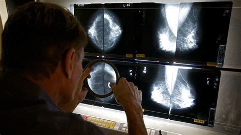 Most Older Breast Cancer Patients Get Too Much Radiation