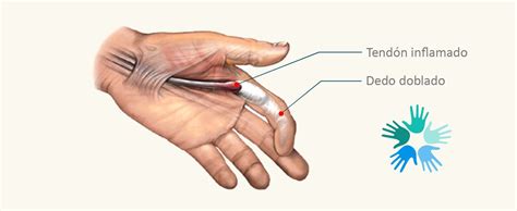 Dedo en Resorte o Tenosinovitis Estenosante Doctor Pedro Sánchez Angulo