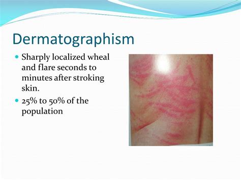 Ppt Allergy Urticaria Angioedema Shock Anaphylactic Powerpoint